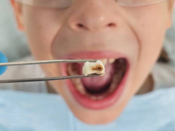 Best Emergency Tooth Extraction in Lla Lla East, WA